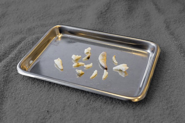 extracted teeth on a tray for article on stomatitis in cats