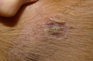 Lesion on a dog's collar for article on what is pyoderma in dogs